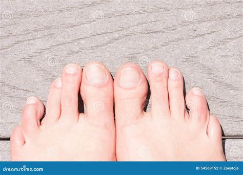 ugly feet pics|375 Images Of Ugly Feet Stock Photos & High